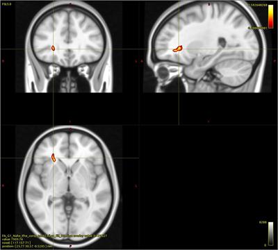 Pinpointing Neural Correlates of Attachment in Poly-Drug Use: A Diffusion Tensor Imaging Study